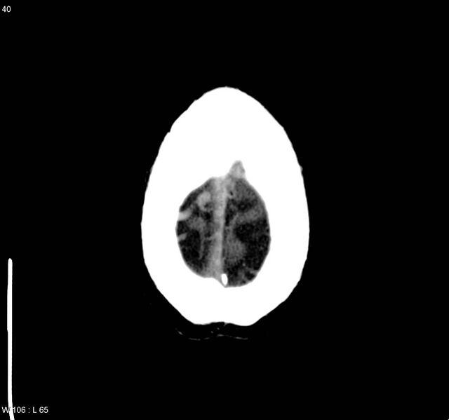 File:Cerebral vein thrombosis (Radiopaedia 4408-6628 Axial non-contrast 7).jpg