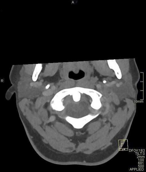 File:Cerebral venous sinus thrombosis (Radiopaedia 91329-108965 Axial venogram 6).jpg