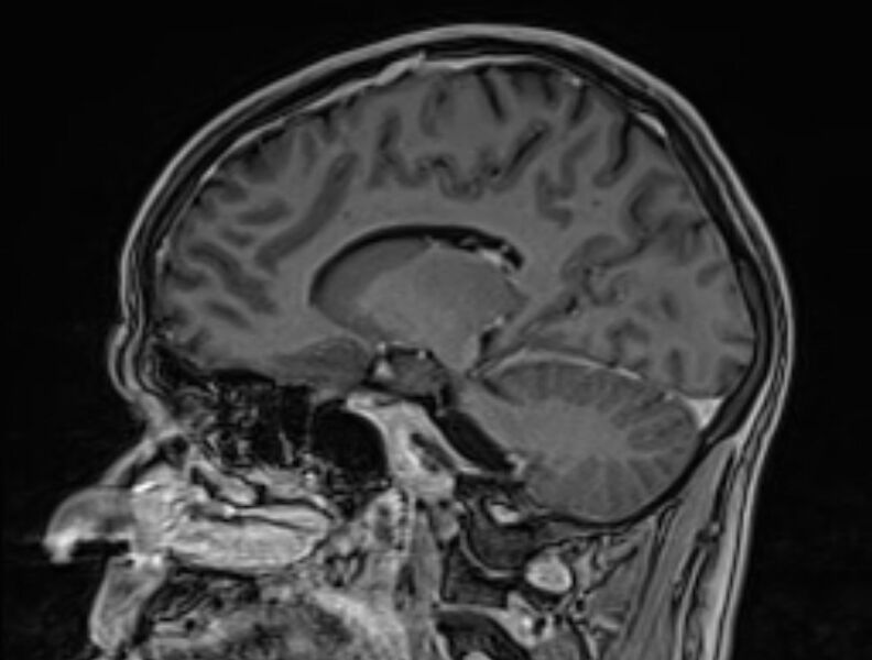 File:Cerebral venous thrombosis (Radiopaedia 71207-81504 Sagittal T1 C+ 37).jpg
