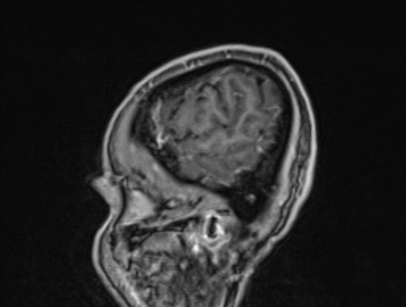 File:Cerebral venous thrombosis (Radiopaedia 71207-81504 Sagittal T1 C+ 59).jpg