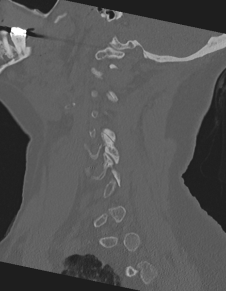 File:Cervical spine ACDF loosening (Radiopaedia 48998-54071 Sagittal bone window 27).png