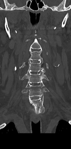 File:Cervical spine fracture - chalk stick (Radiopaedia 39116-41323 Coronal bone window 16).png