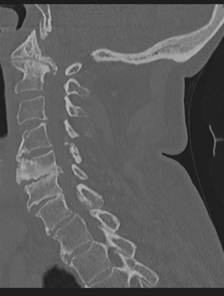 File:Cervical spondylolysis (Radiopaedia 49616-54811 Sagittal bone window 33).png