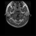 Cervical vertebrae metastasis (Radiopaedia 78814-91667 Axial T1 12).png
