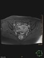 Cesarian scar endometriosis (Radiopaedia 68495-78066 Axial T1 C+ fat sat 13).jpg