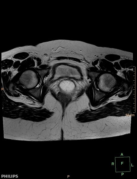 File:Cesarian scar endometriosis (Radiopaedia 68495-78066 Axial T2 20).jpg