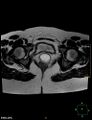 Cesarian scar endometriosis (Radiopaedia 68495-78066 Axial T2 20).jpg