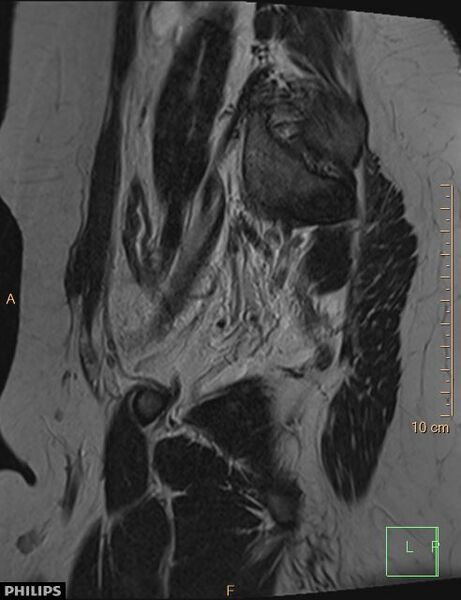 File:Cesarian scar endometriosis (Radiopaedia 68495-78066 Sagittal T2 24).jpg