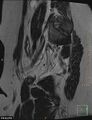 Cesarian scar endometriosis (Radiopaedia 68495-78066 Sagittal T2 24).jpg
