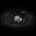Cesarian section scar endometriosis (Radiopaedia 66520-75799 Axial DWI 60).jpg