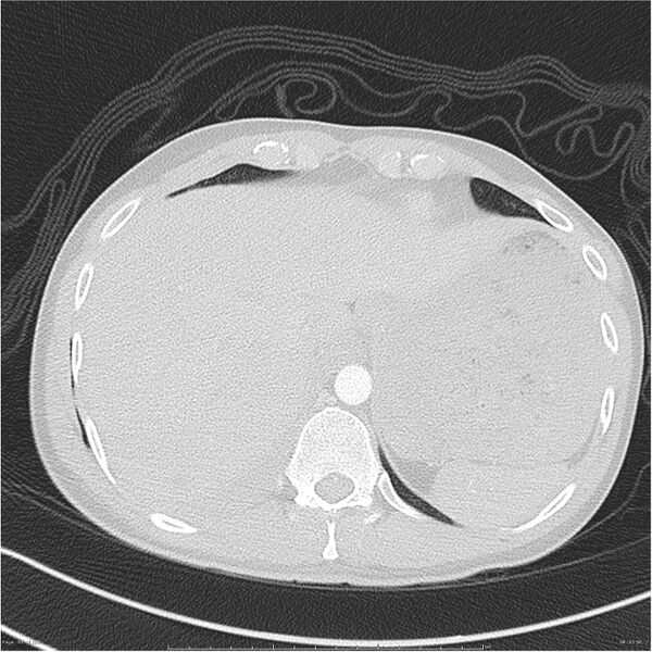 File:Chest and abdomen multi-trauma (Radiopaedia 26294-26425 lung window 91).jpg
