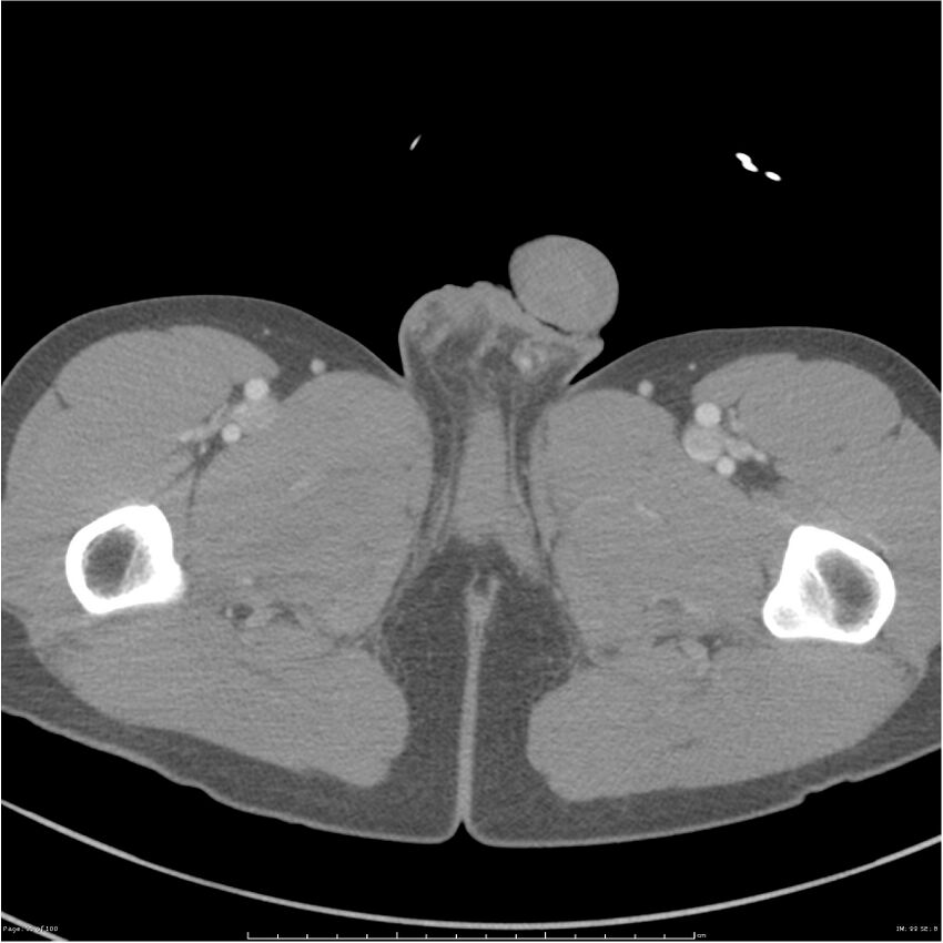 Chest and abdomen multi-trauma (Radiopaedia 26294-26426 bone window 99).jpg