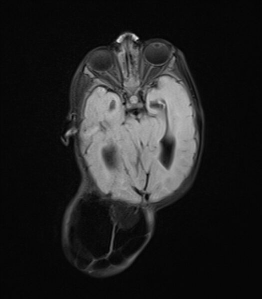 File:Chiari III malformation with occipital encephalocele (Radiopaedia 79446-92559 Axial FLAIR 13).jpg