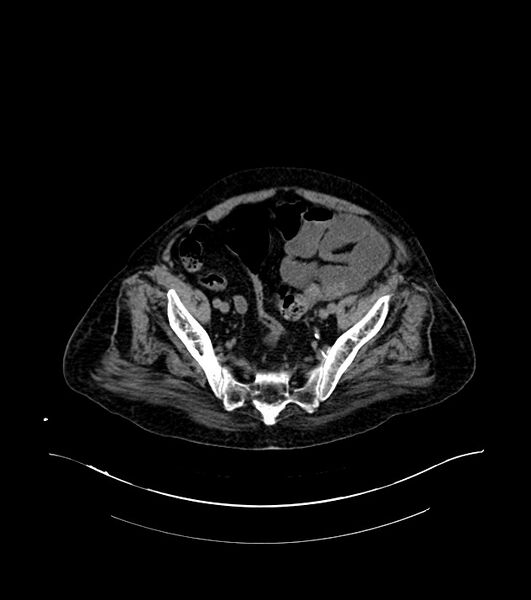File:Cholangiocarcinoma with cerebral metastases (Radiopaedia 83519-98629 Axial non-contrast 103).jpg