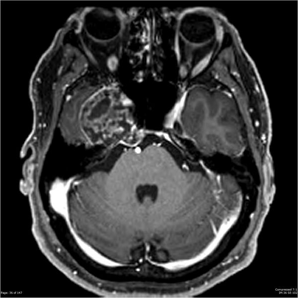 File:Chondrosarcoma of skull base- grade II (Radiopaedia 40948-43654 Axial T1 C+ 24).jpg