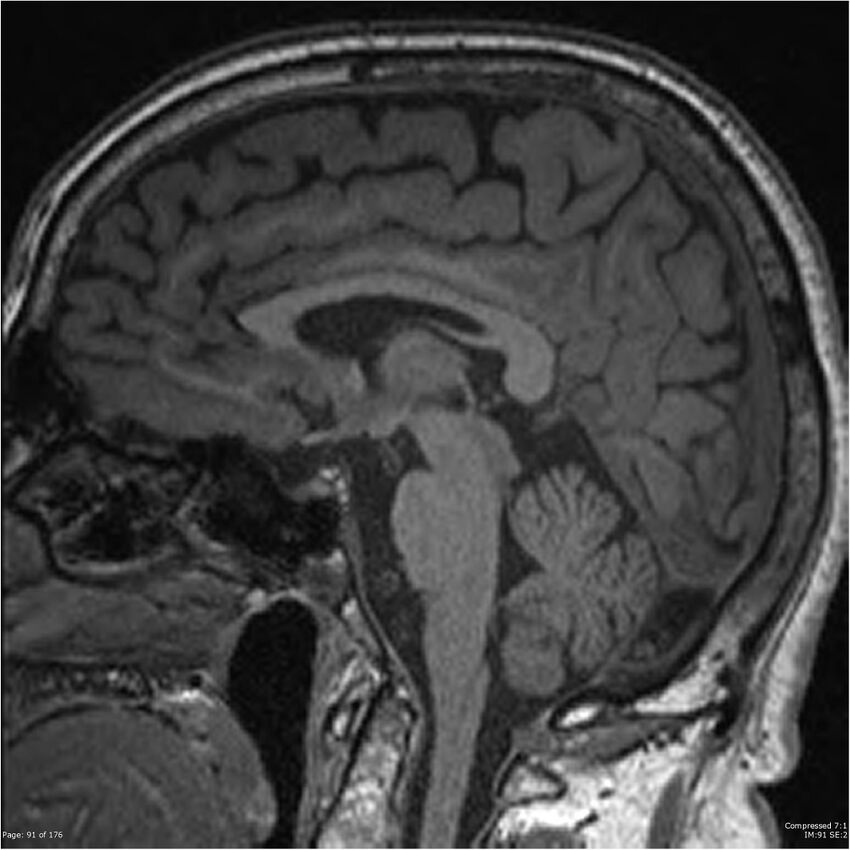 Chondrosarcoma of skull base- grade II (Radiopaedia 40948-43654 Sagittal T1 14).jpg