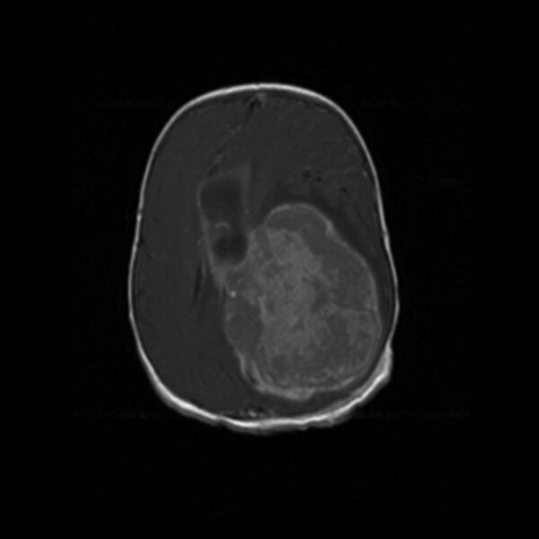 File:Choroid plexus carcinoma (Radiopaedia 21121-21035 Axial T1 C+ 13).jpg