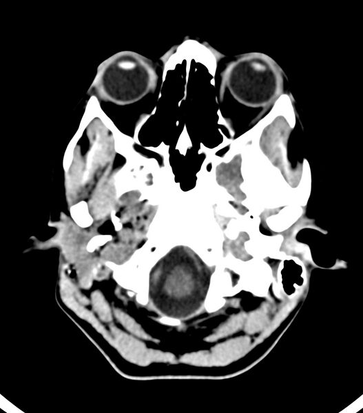 File:Choroid plexus carcinoma (Radiopaedia 91013-108552 Axial non-contrast 10).jpg