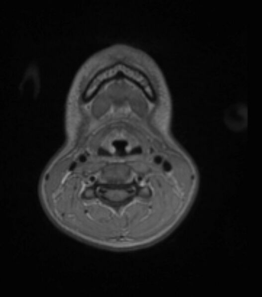 File:Choroid plexus carcinoma (Radiopaedia 91013-108553 Axial T1 C+ 15).jpg