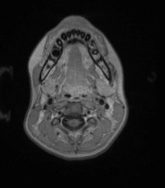 File:Choroid plexus carcinoma (Radiopaedia 91013-108553 Axial T1 C+ 30).jpg