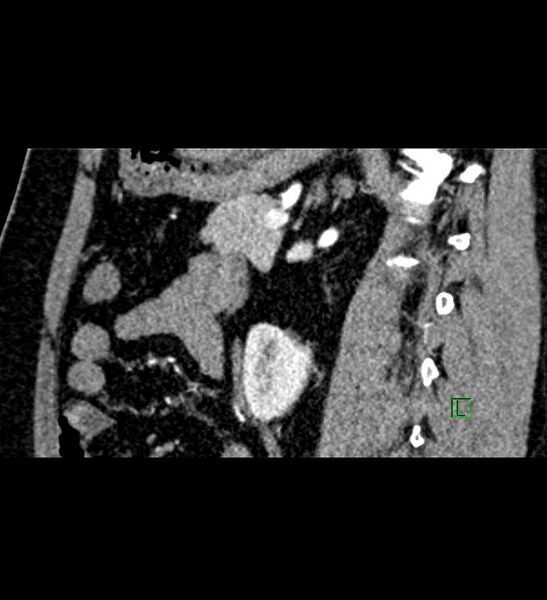 File:Chromophobe renal cell carcinoma (Radiopaedia 84286-99573 F 66).jpg