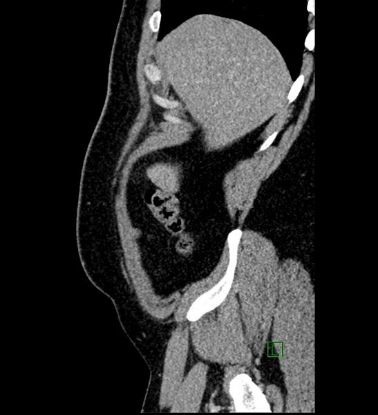 File:Chromophobe renal cell carcinoma (Radiopaedia 84286-99573 I 168).jpg