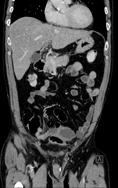File:Chronic appendicitis complicated by appendicular abscess, pylephlebitis and liver abscess (Radiopaedia 54483-60700 C 28).jpg