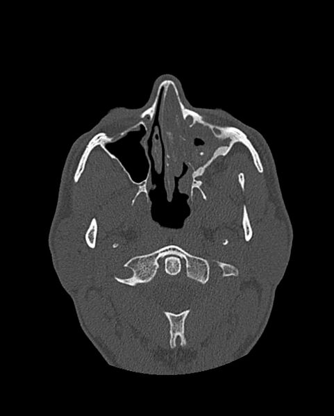 File:Chronic maxillary sinusitis caused by a foreign body (Radiopaedia 58521-65676 Axial bone window 135).jpg