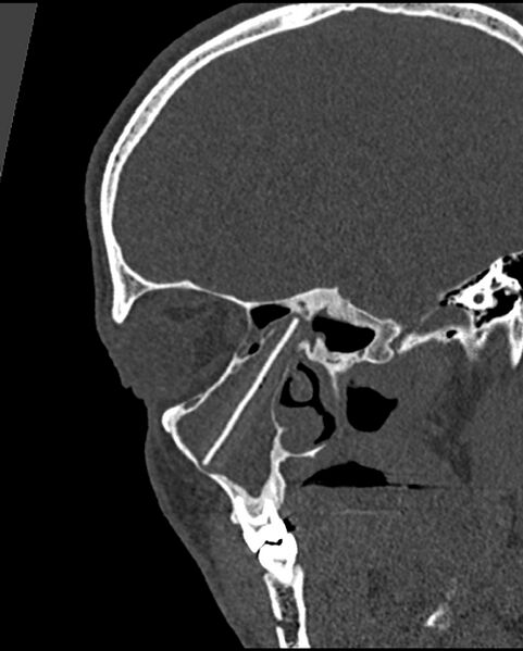 File:Chronic maxillary sinusitis caused by a foreign body (Radiopaedia 58521-65676 Sagittal bone window 26).jpg