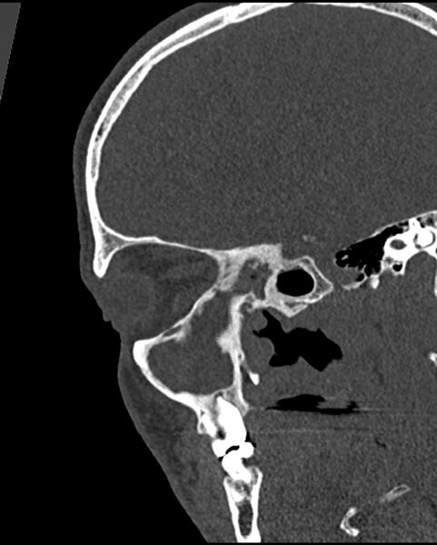 File:Chronic maxillary sinusitis caused by a foreign body (Radiopaedia 58521-65676 Sagittal bone window 38).jpg