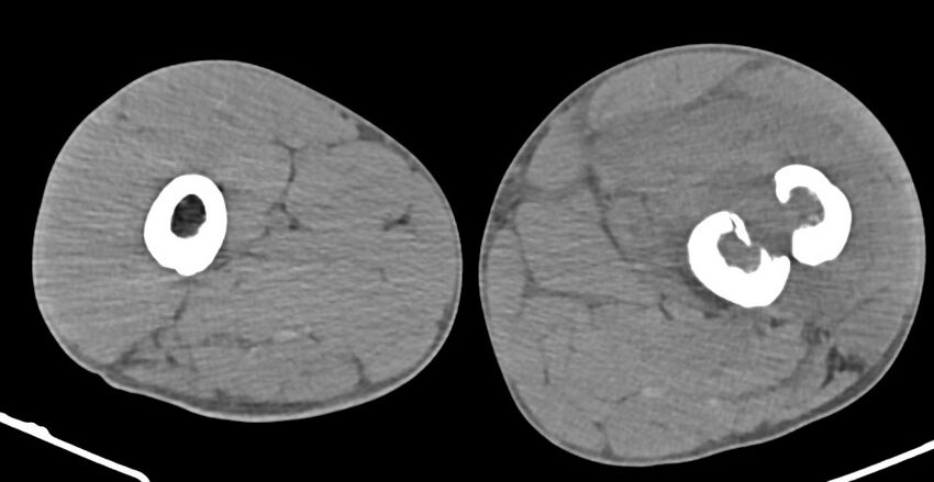 Chronic osteomyelitis (with sequestrum) (Radiopaedia 74813-85822 D 84).jpg