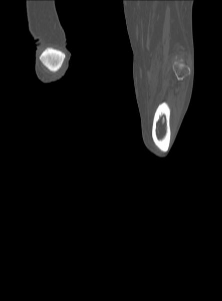 File:Chronic osteomyelitis - tibia (with sequestrum) (Radiopaedia 73273-84090 Coronal non-contrast 63).jpg