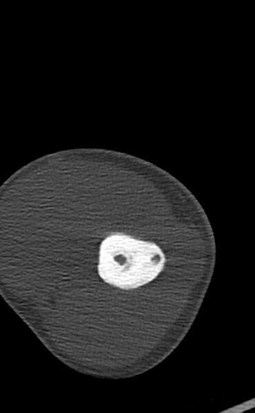 File:Chronic osteomyelitis of the distal humerus (Radiopaedia 78351-90971 Axial bone window 51).jpg