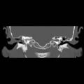 Chronic otomastoiditis (Radiopaedia 27138-27309 Coronal bone window 9).jpg