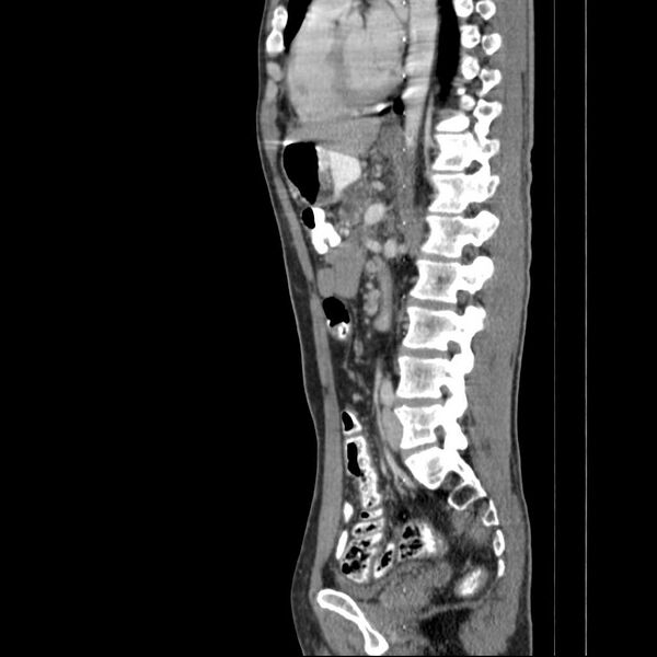File:Chronic pancreatitis (Radiopaedia 21022-20949 D 9).jpg