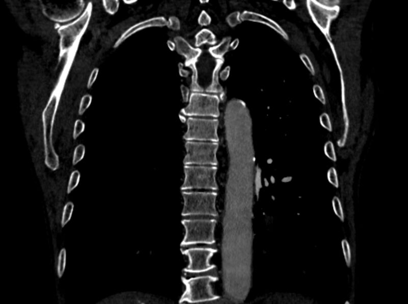File:Chronic pulmonary embolism (Radiopaedia 91241-108843 A 82).jpg