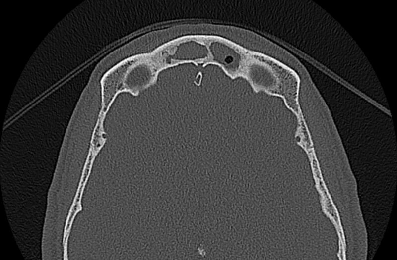 File:Chronic rhinosinusitis (Radiopaedia 65079-74075 Axial bone window 74).jpg