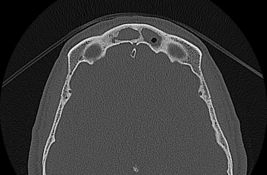 Chronic rhinosinusitis (Radiopaedia 65079-74075 Axial bone window 74).jpg