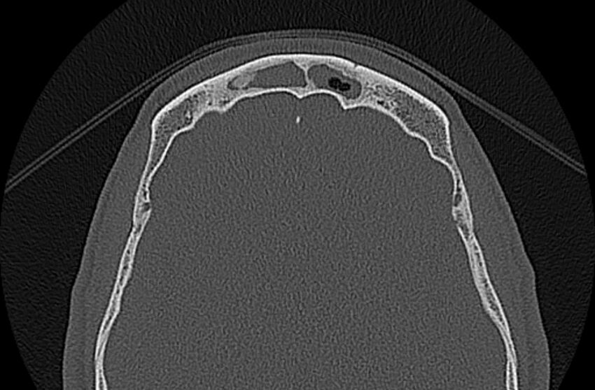 Chronic rhinosinusitis (Radiopaedia 65079-74075 Axial bone window 77).jpg