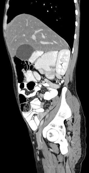 File:Chronic small bowel volvulus (Radiopaedia 75224-86322 C 104).jpg