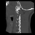 Clay-shoveler fracture (Radiopaedia 22568-22590 Sagittal bone window 37).jpg