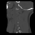 Clay-shoveler fracture (Radiopaedia 22568-22590 Sagittal bone window 43).jpg