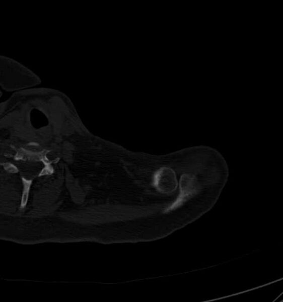 File:Clear cell chondrosarcoma - humerus (Radiopaedia 63104-71612 Axial bone window 7).jpg
