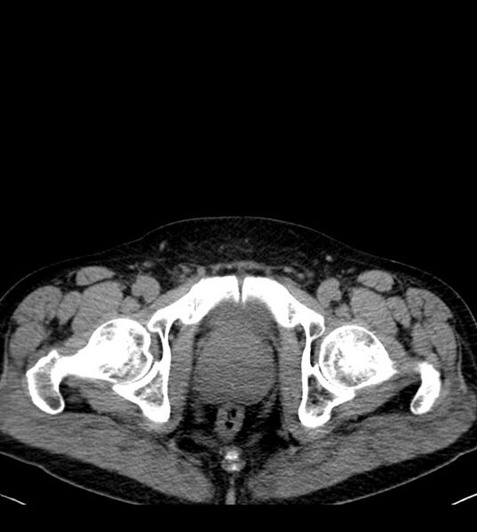 File:Clear cell renal cell carcinoma (Radiopaedia 85006-100539 Axial non-contrast 86).jpg