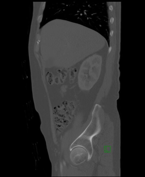 File:Clear cell renal cell carcinoma (Radiopaedia 85006-100539 Sagittal bone window 46).jpg