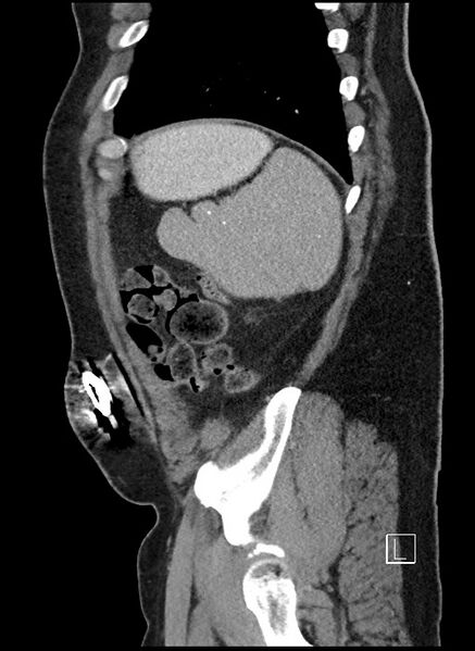 File:Closed loop obstruction - internal hernia into nephrectomy bed (Radiopaedia 59867-67320 C 7).jpg