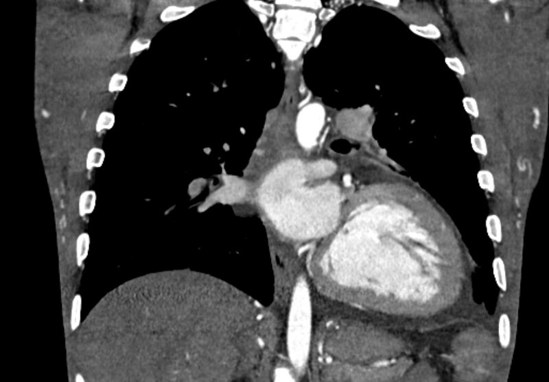 File:Coarctation of aorta with aortic valve stenosis (Radiopaedia 70463-80574 C 149).jpg