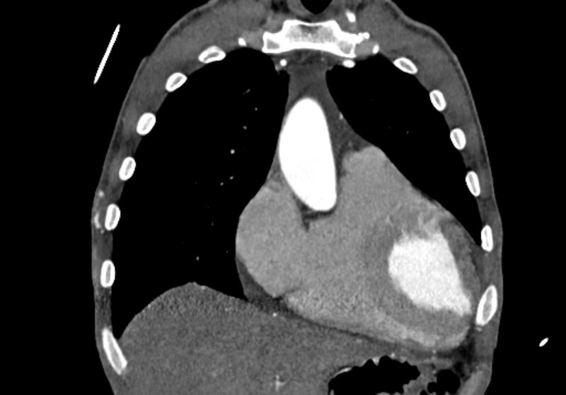 File:Coarctation of aorta with aortic valve stenosis (Radiopaedia 70463-80574 C 47).jpg