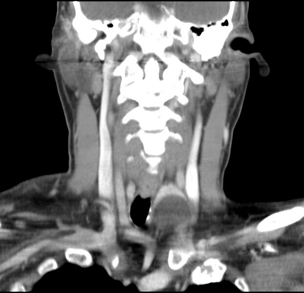 File:Colloid cyst of thyroid (Radiopaedia 22897-22923 Coronal C+ delayed 32).jpg