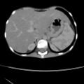 Colocolic fistula - Crohn disease (Radiopaedia 57063-63955 A 11).jpg